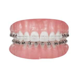 Orthodontics Braces - Dental Treatment Speciality at Smile Mantra Dental and Cosmetic Clinic